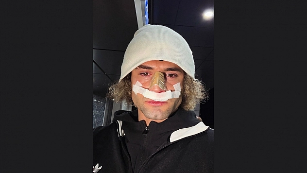 Elazığspor'a Kötü Haber: Fuat Bavuk'un Burnu Kırıldı