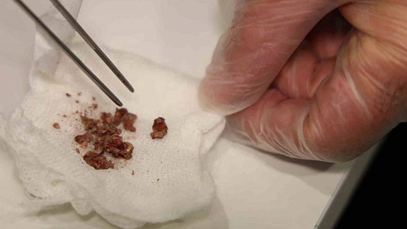 Hastanın burnundan taş çıkarıldı.