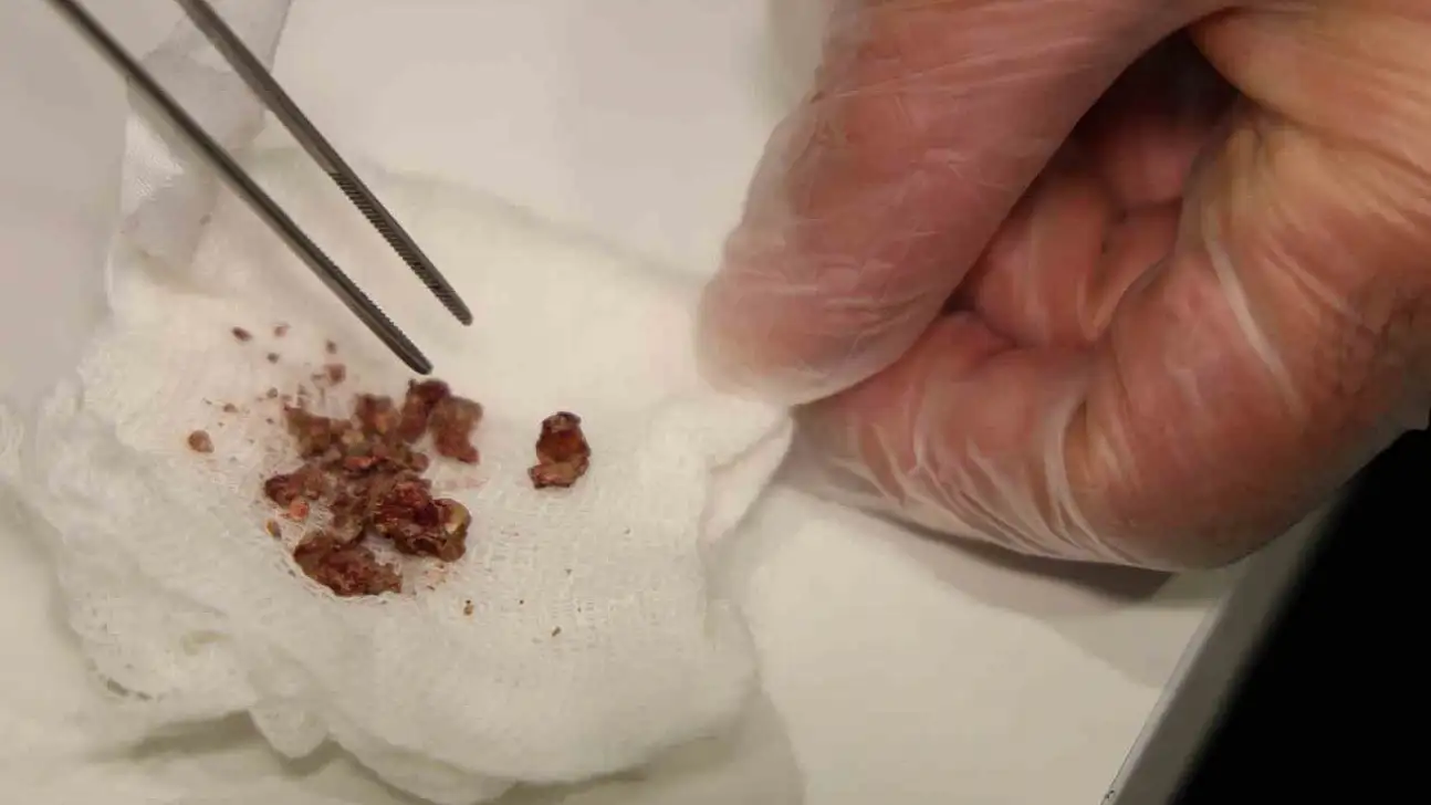 Hastanın burnundan taş çıkarıldı.